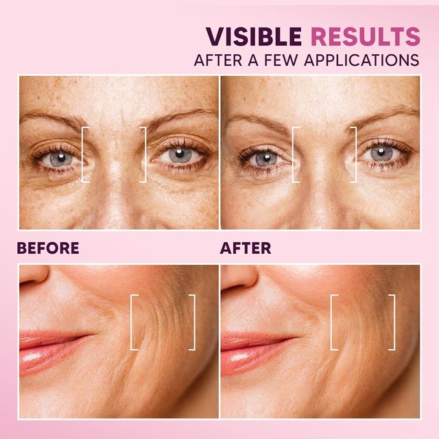 BOTOX---PRIJE-POSLIJE--ENG